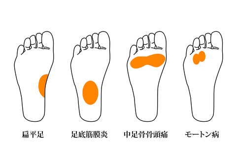 足底筋膜炎