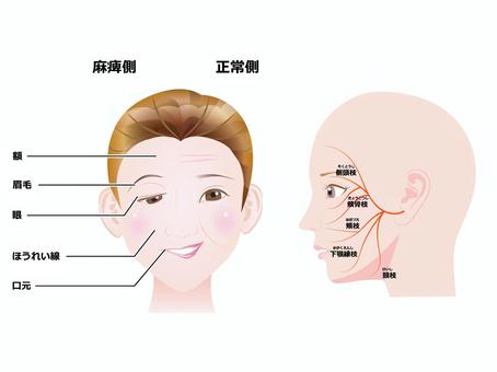 顔面神経麻痺